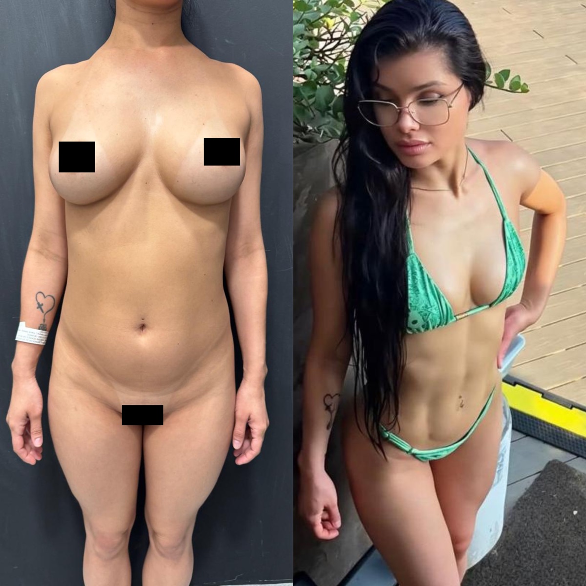 Antes e depois — caso 1